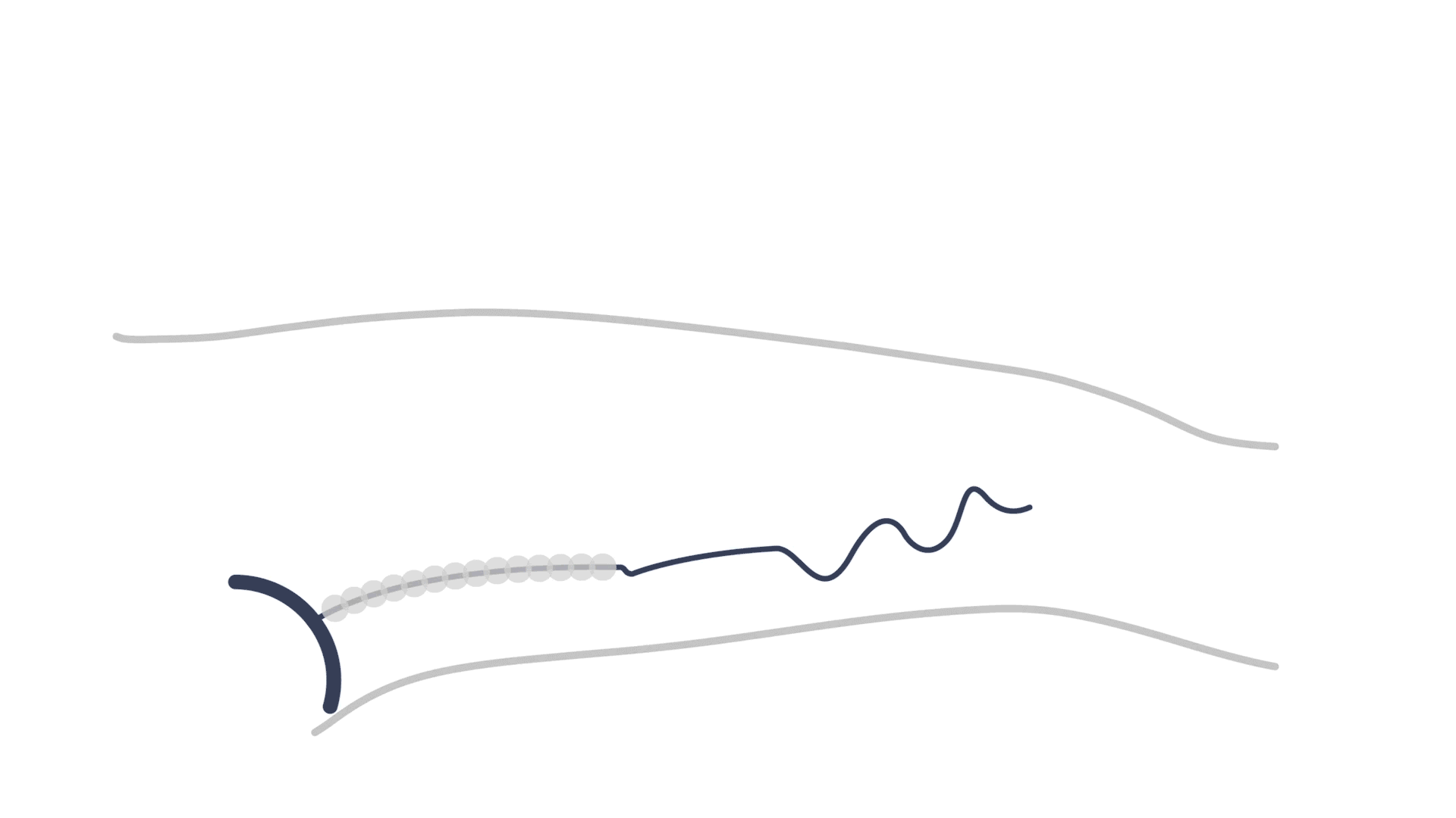 SONOVEIN echotherapy